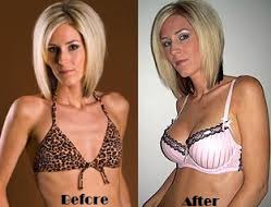 breast actives before and after images