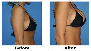 breast actives before and after pictures