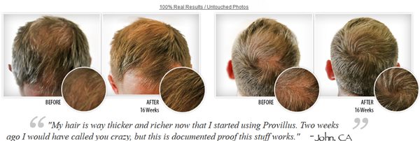 provillus men hair regrowth tretament