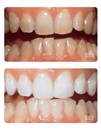 idol teeth whitening results